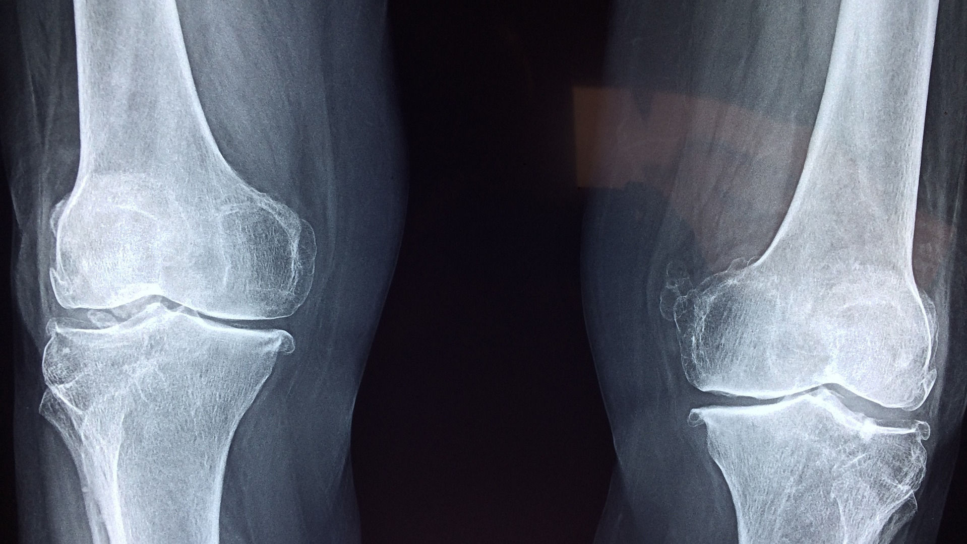 Osteoporosis 