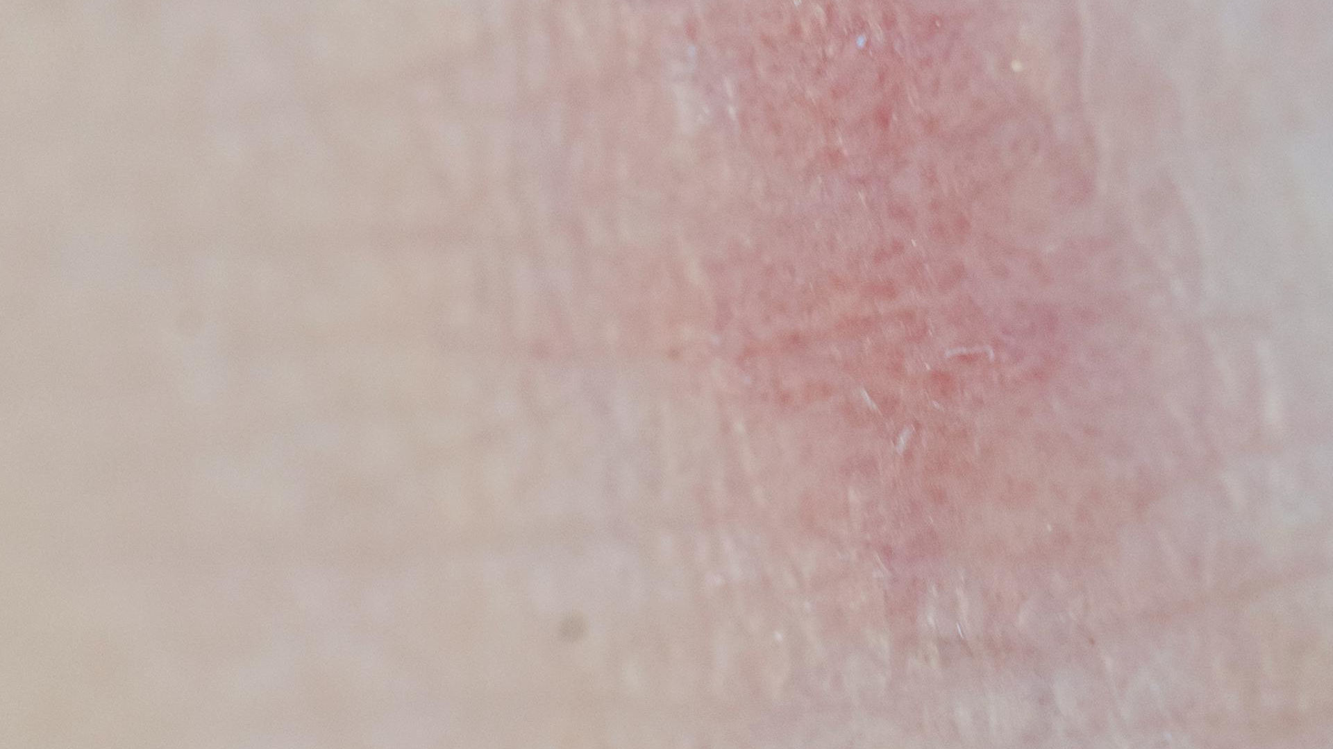 Atopic Dermatitis Rash on Skin